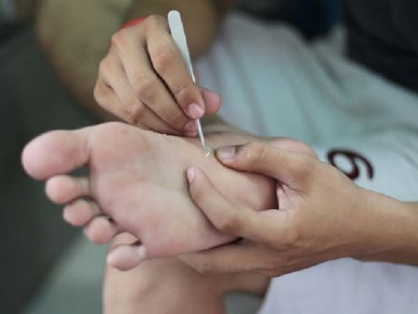 Các mẹo lấy dằm khỏi chân